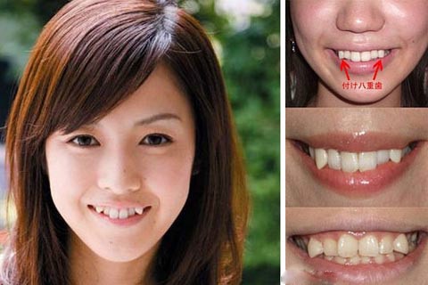 trends dental jewelry snaggleteeth